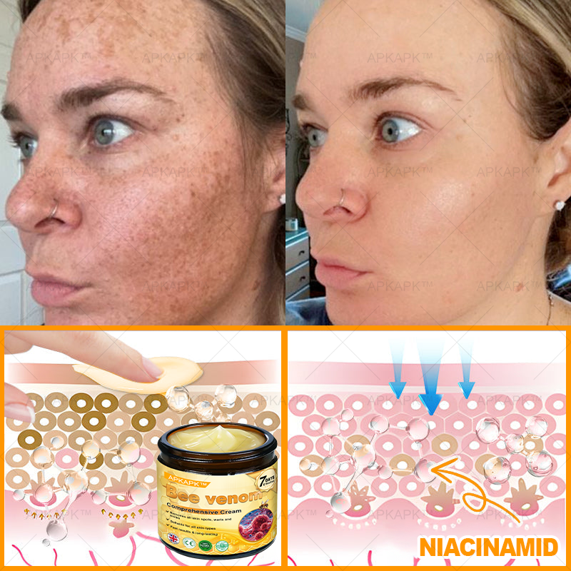 🐝✨ APKAPK® Bee venom Comprehensive Cream 🔥 Sagging Skin, Fine Lines, Loss of Firmness, Flat Bust, Drooping Hips, and More